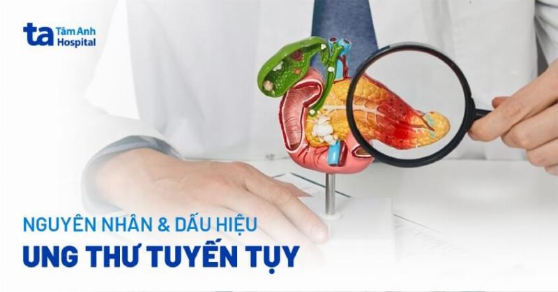 Ung Thư Tuyến Tụy Có Chữa Được Không? Tìm Hiểu Chi Tiết